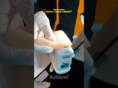 testimoniare la potenza di sollevamento non invasiva di HIFU