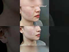 Avete provato l'HIFU RF+ per la stretta della pelle? #Antiaging #SkinLift #beautyclinic #facialtreatment